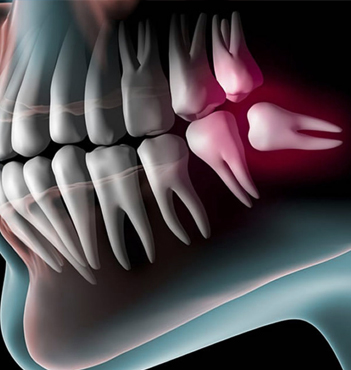 Dente do siso ( 3º molar )