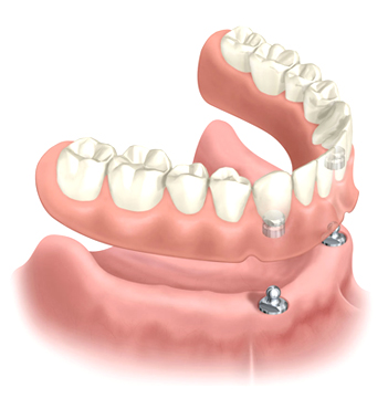 Overdenture